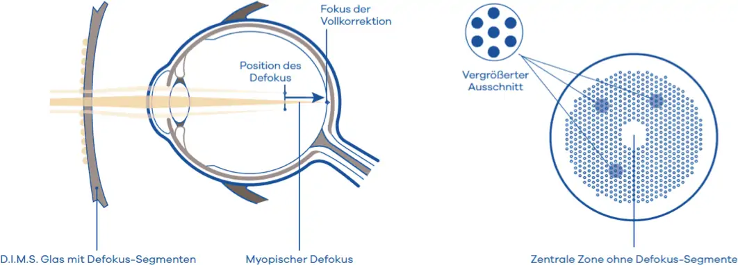 Funktionsweise der innovativen D.I.M.S. Technologie bei Miyosmart